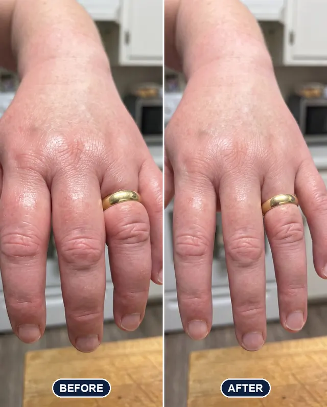 Swollen fingers before and after