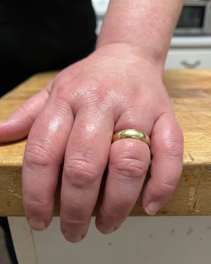 Ring sunk into a swollen finger