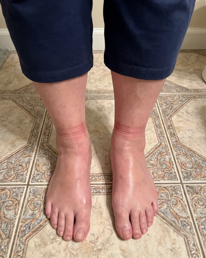 Swollen ankles with deep sock grooves