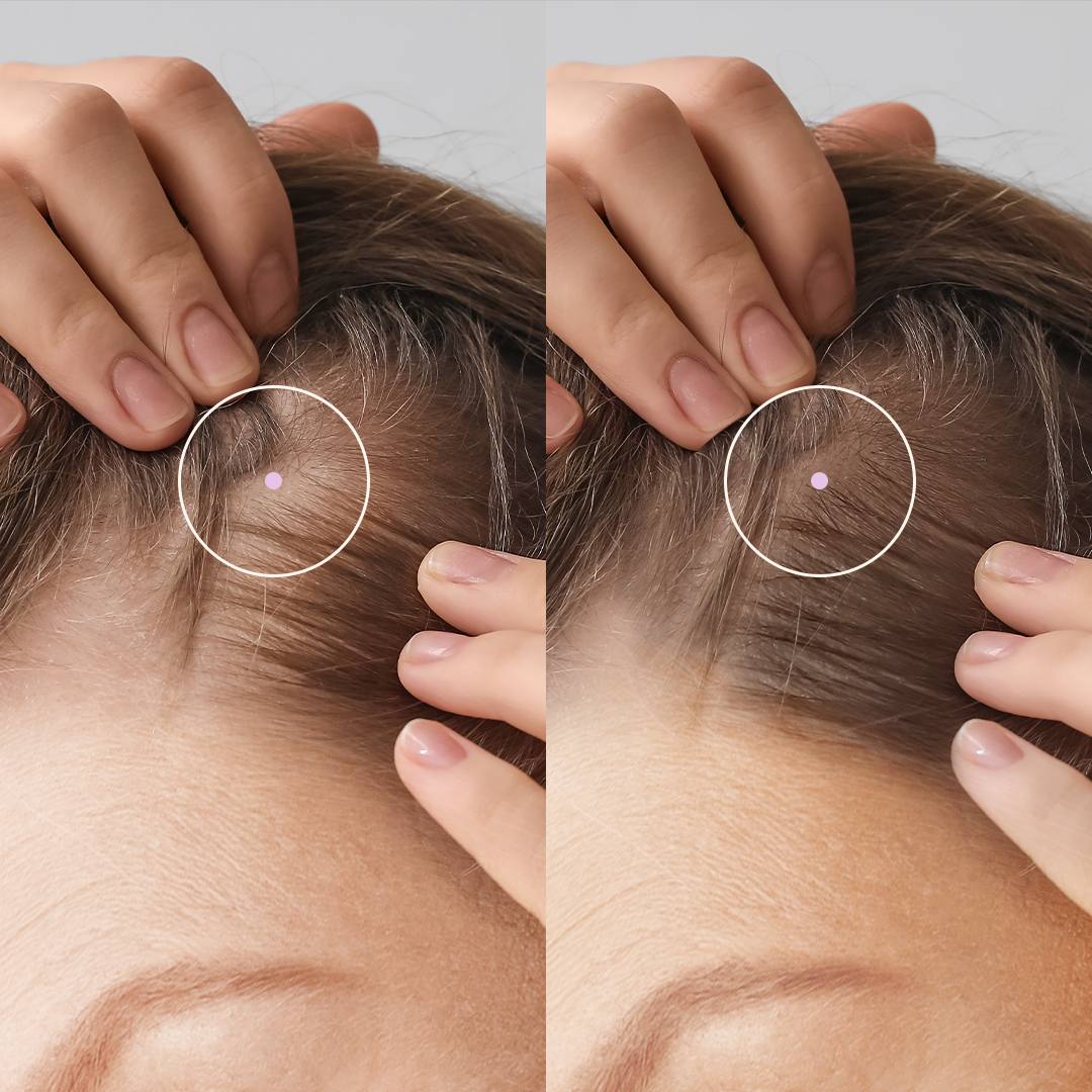 Close-up of a person's scalp with hands parting hair, highlighting a small spot.