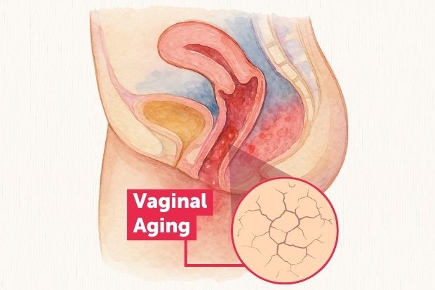 A medical illustration depicting vaginal aging, with a cross-section of the female reproductive system and magnified dryness.