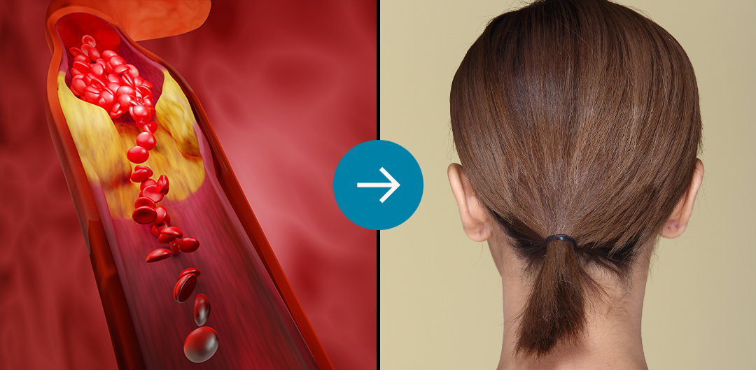 Split image: artery with red blood cells, and person's hair from behind.