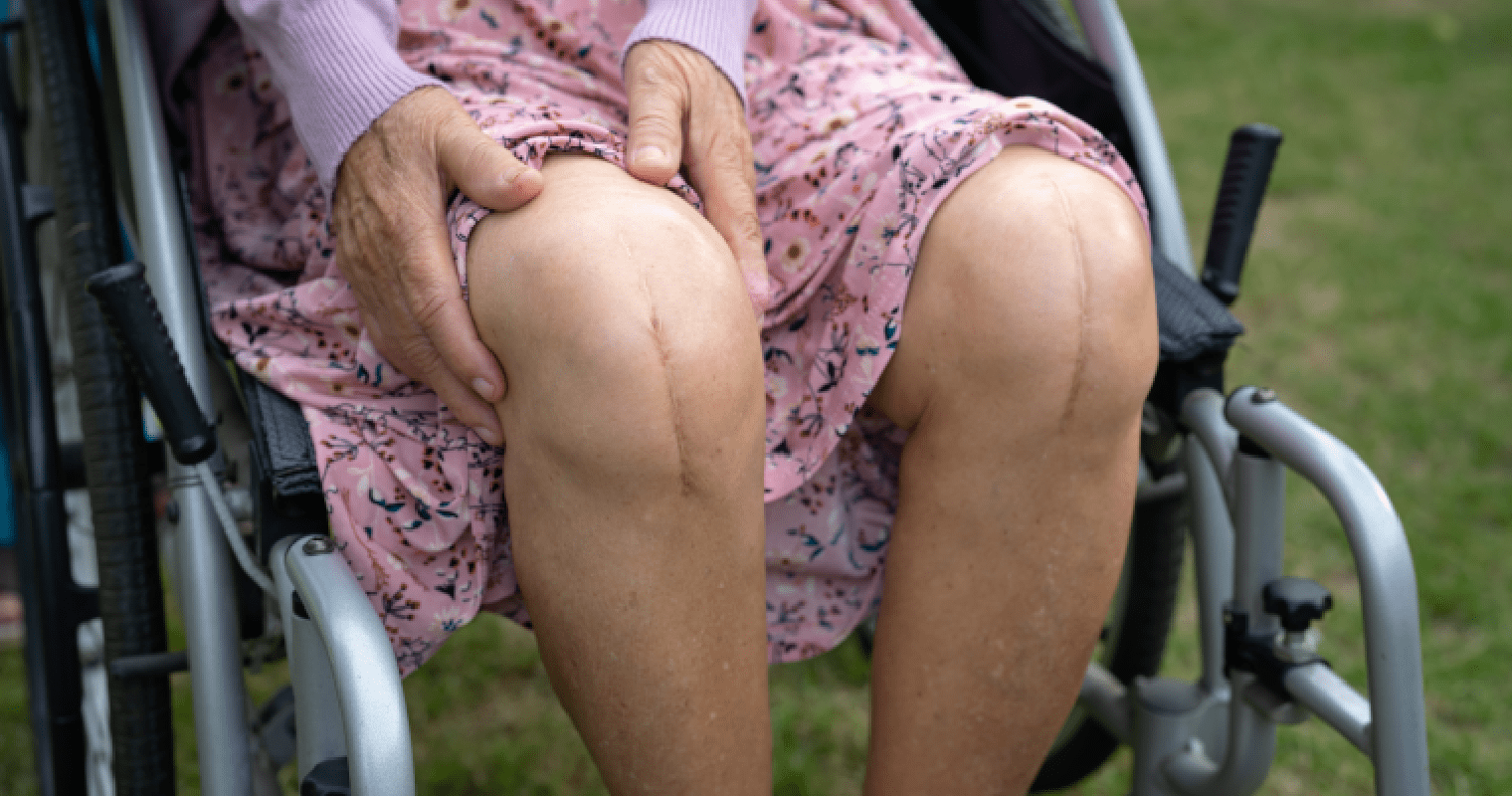 Elderly person in a wheelchair with knee scars.