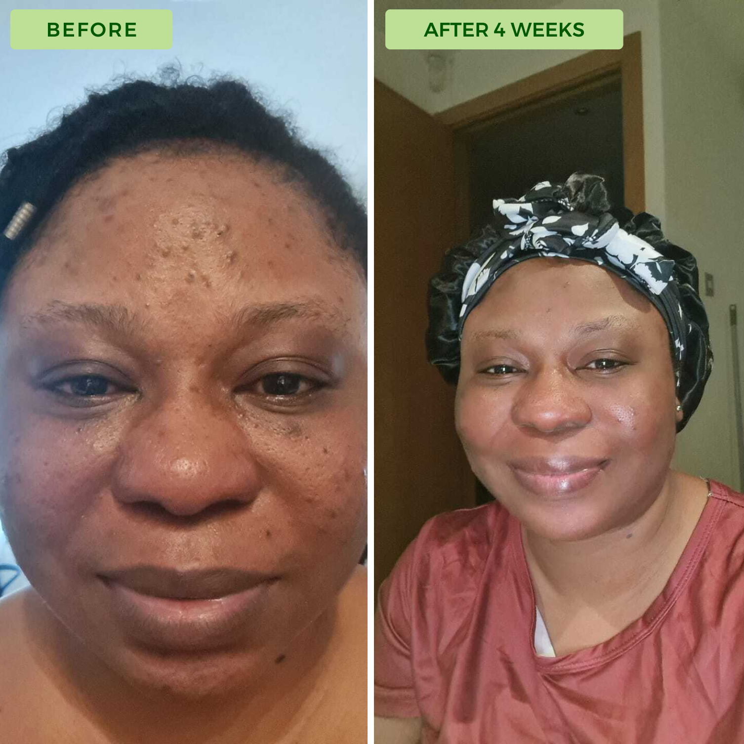 Side-by-side comparison of a woman's face before and after four weeks.
