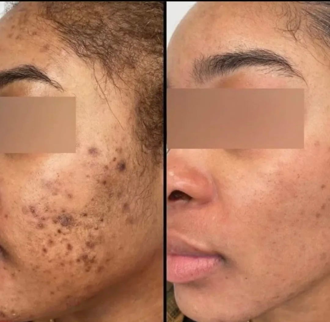 Side-by-side comparison of facial skin before and after treatment.