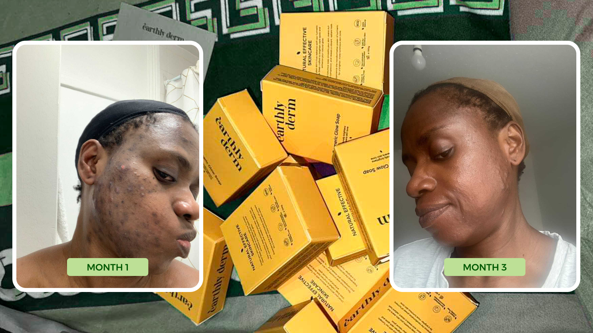 Two side-by-side photos showing skin improvement over three months with skincare products.