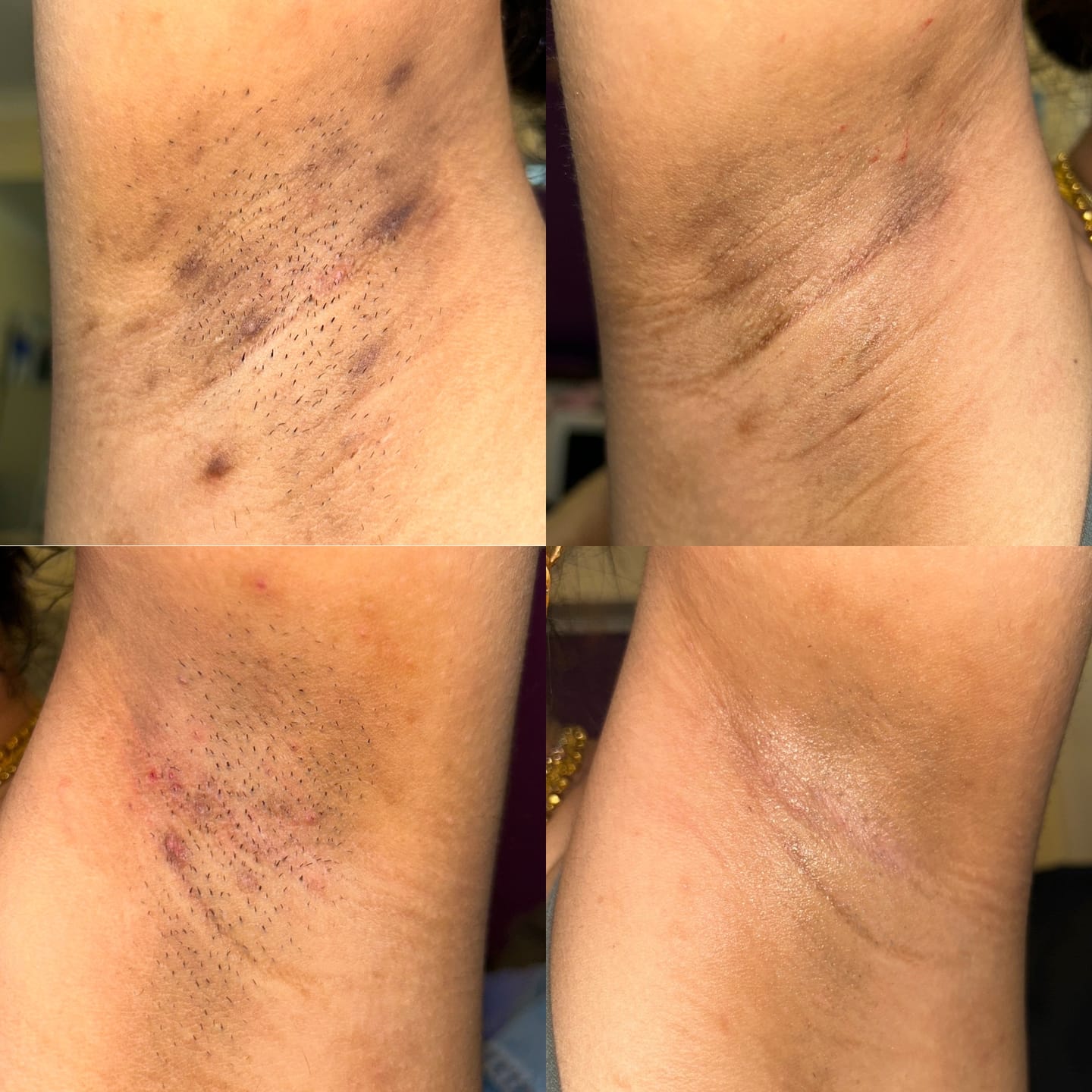 Four close-up images of underarm skin with varying conditions.