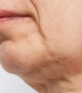 A close-up of a person's chin and jawline, showing wrinkles and sagging skin.