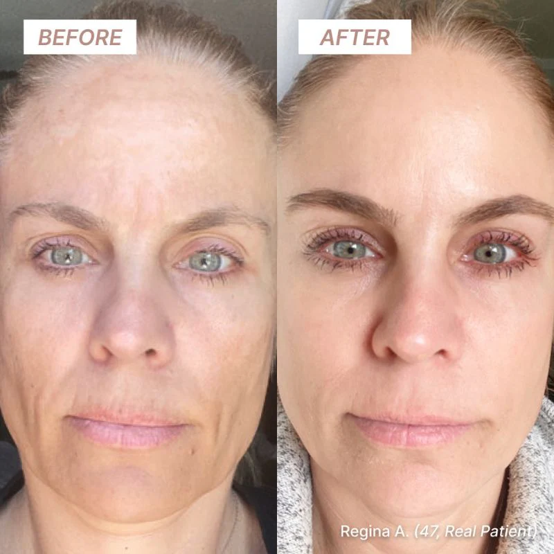 A before-and-after image showing a woman's face with a noticeable reduction in wrinkles and improved skin tone.