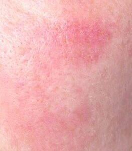 A close-up view of a patch of red, inflamed skin with an uneven texture.