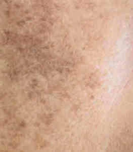 A close-up of human skin with patches of brown hyperpigmentation and sun spots.
