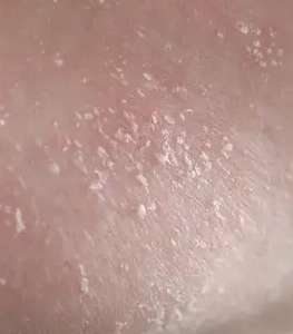 A close-up photograph of dry, flaky human skin.