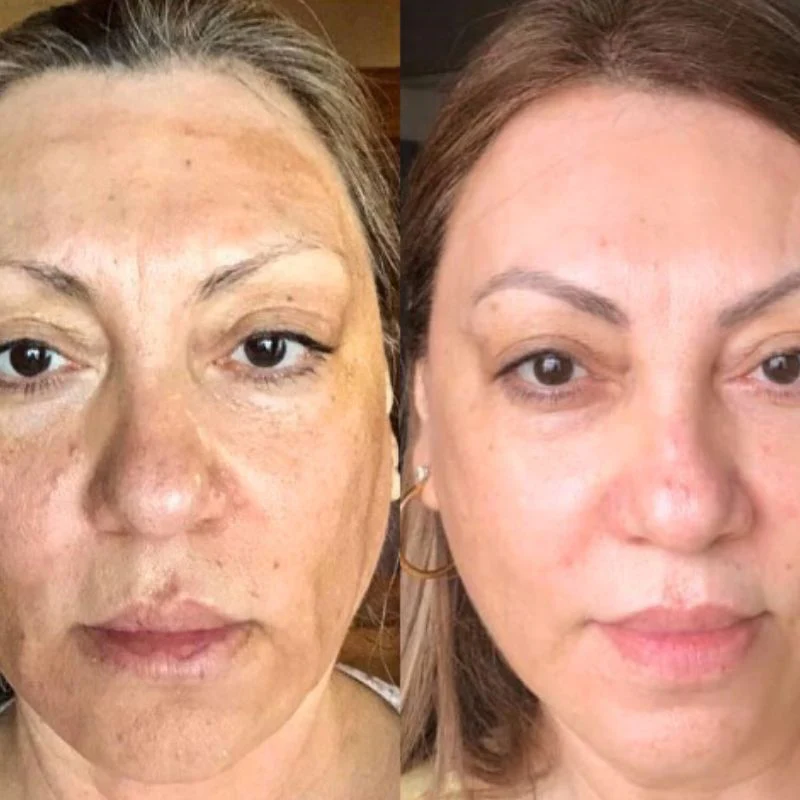 A before and after image of a woman's face showing a significant reduction in skin hyperpigmentation.