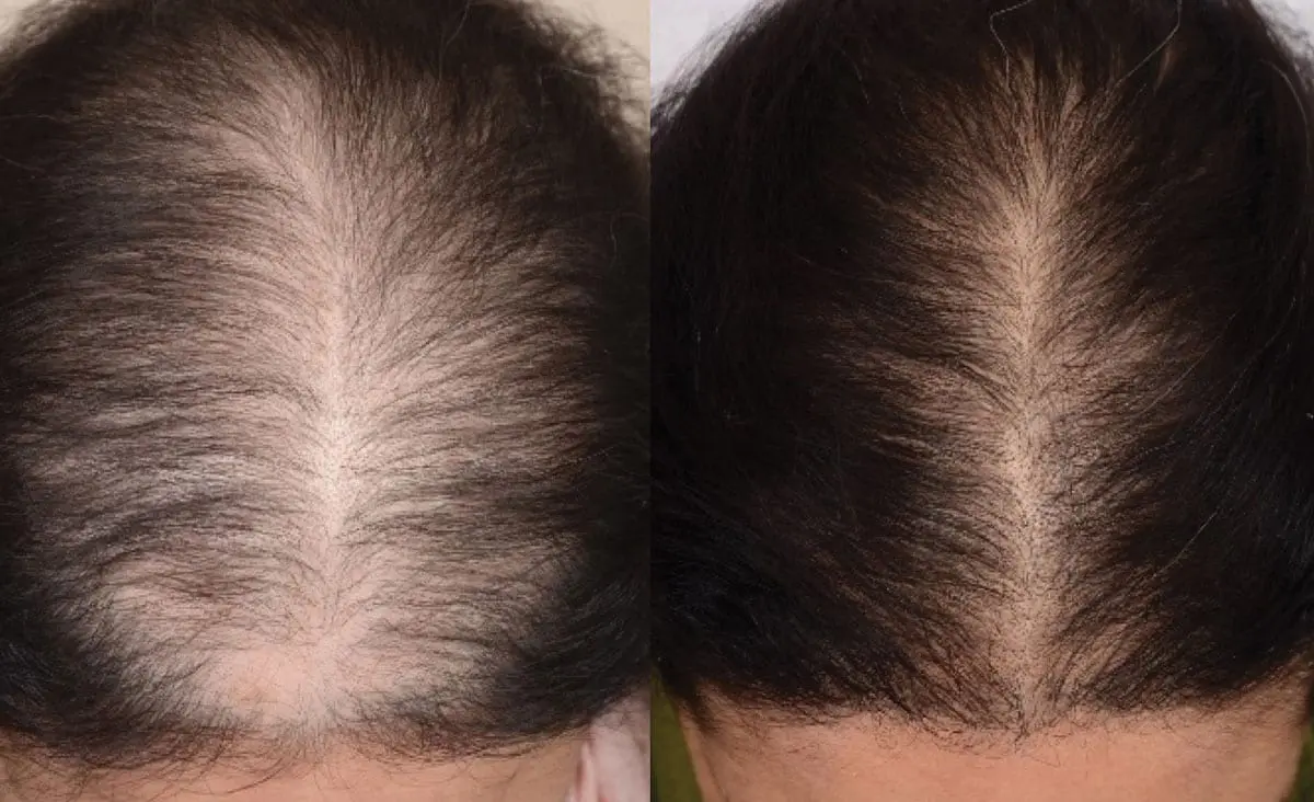Comparison of hair density before and after treatment.