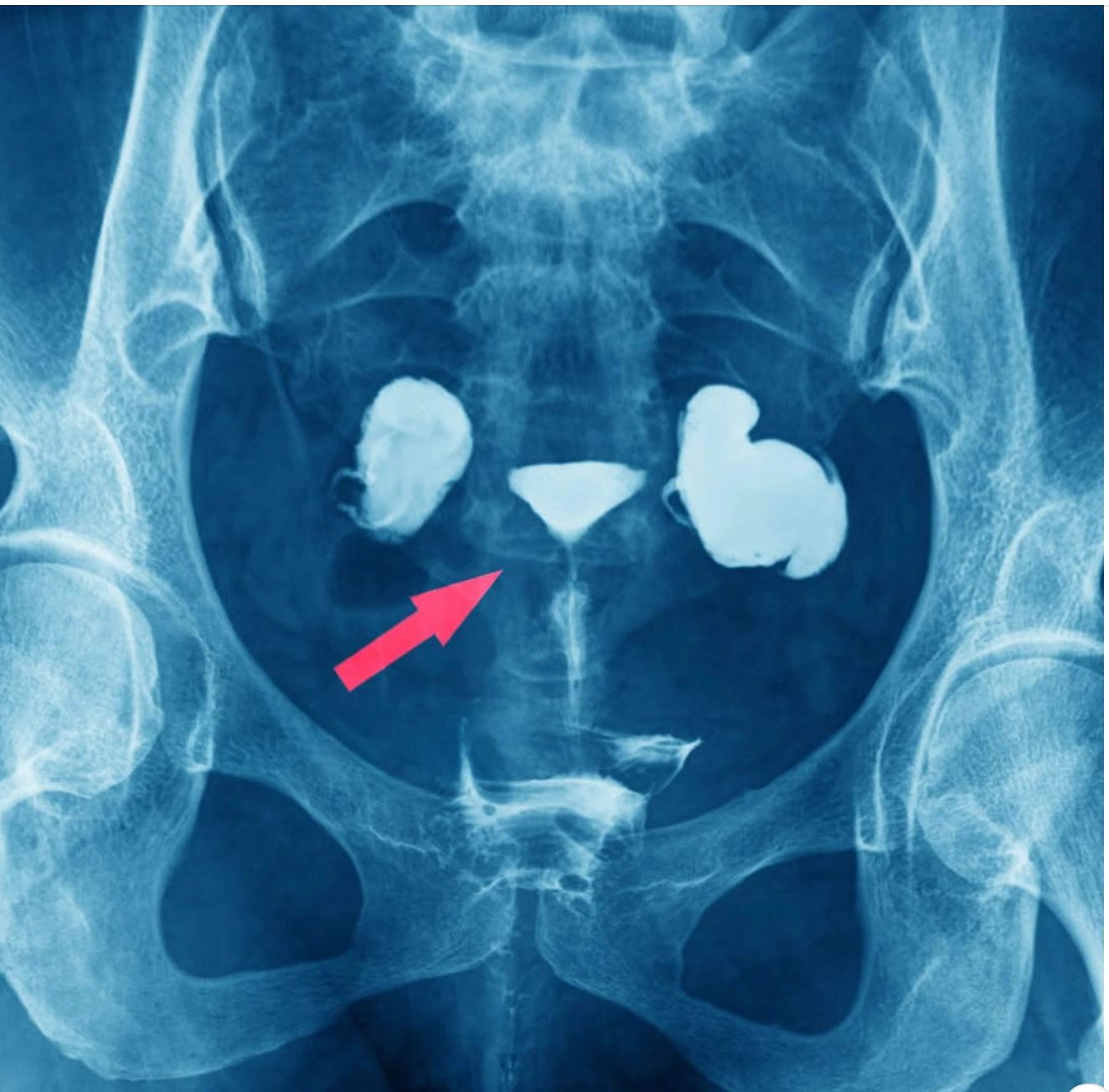 A blue-tinted X-ray of a pelvis with a red arrow pointing to highlighted internal structures.