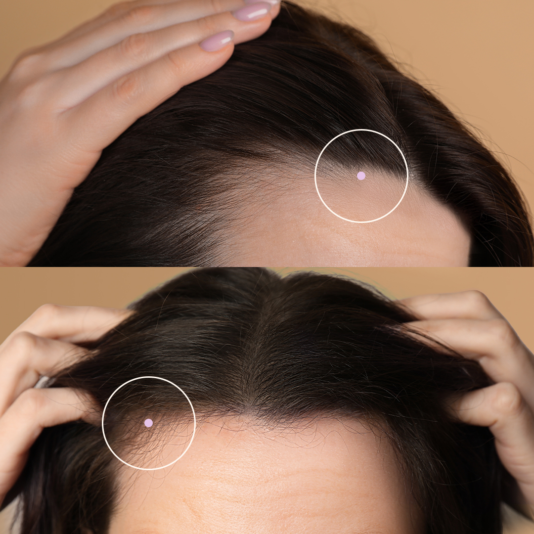 Close-up of a person's scalp with highlighted areas.