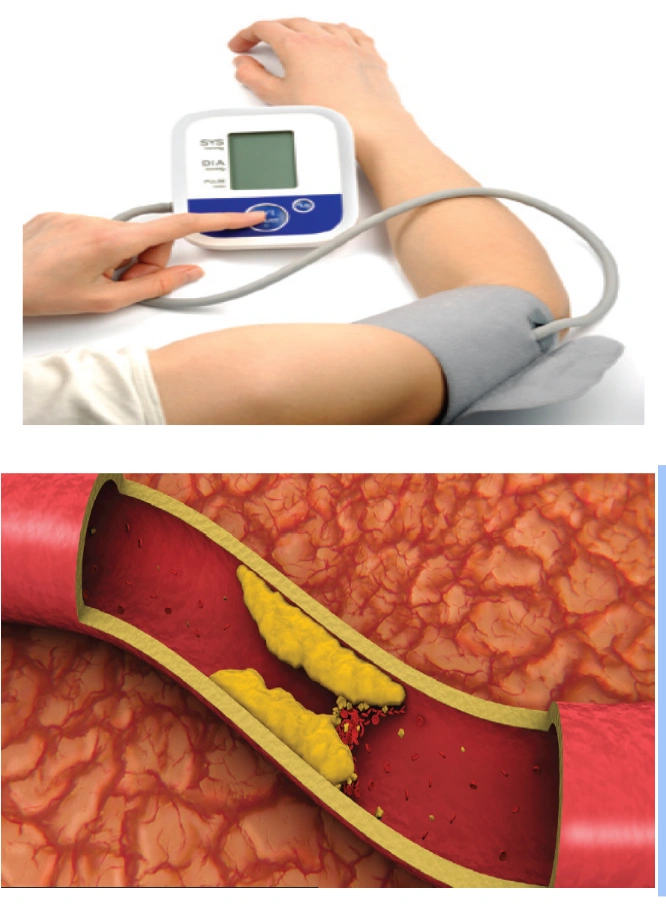 A composite image of a person taking their blood pressure and an illustration of a plaque-clogged artery.