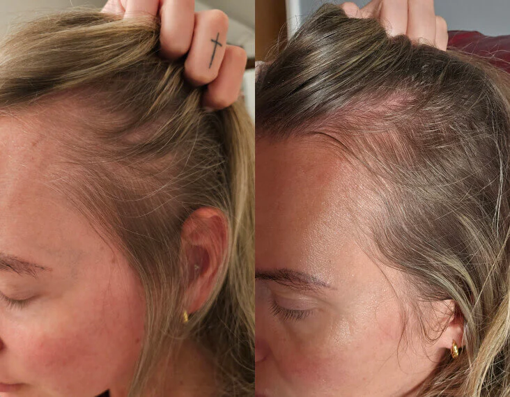 Side-by-side comparison of a woman pulling her hair back to show thinning and then regrowth at her hairline.