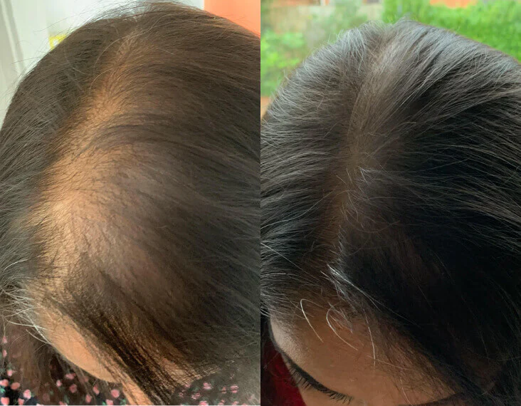 A before and after image showing hair regrowth on a woman's scalp.