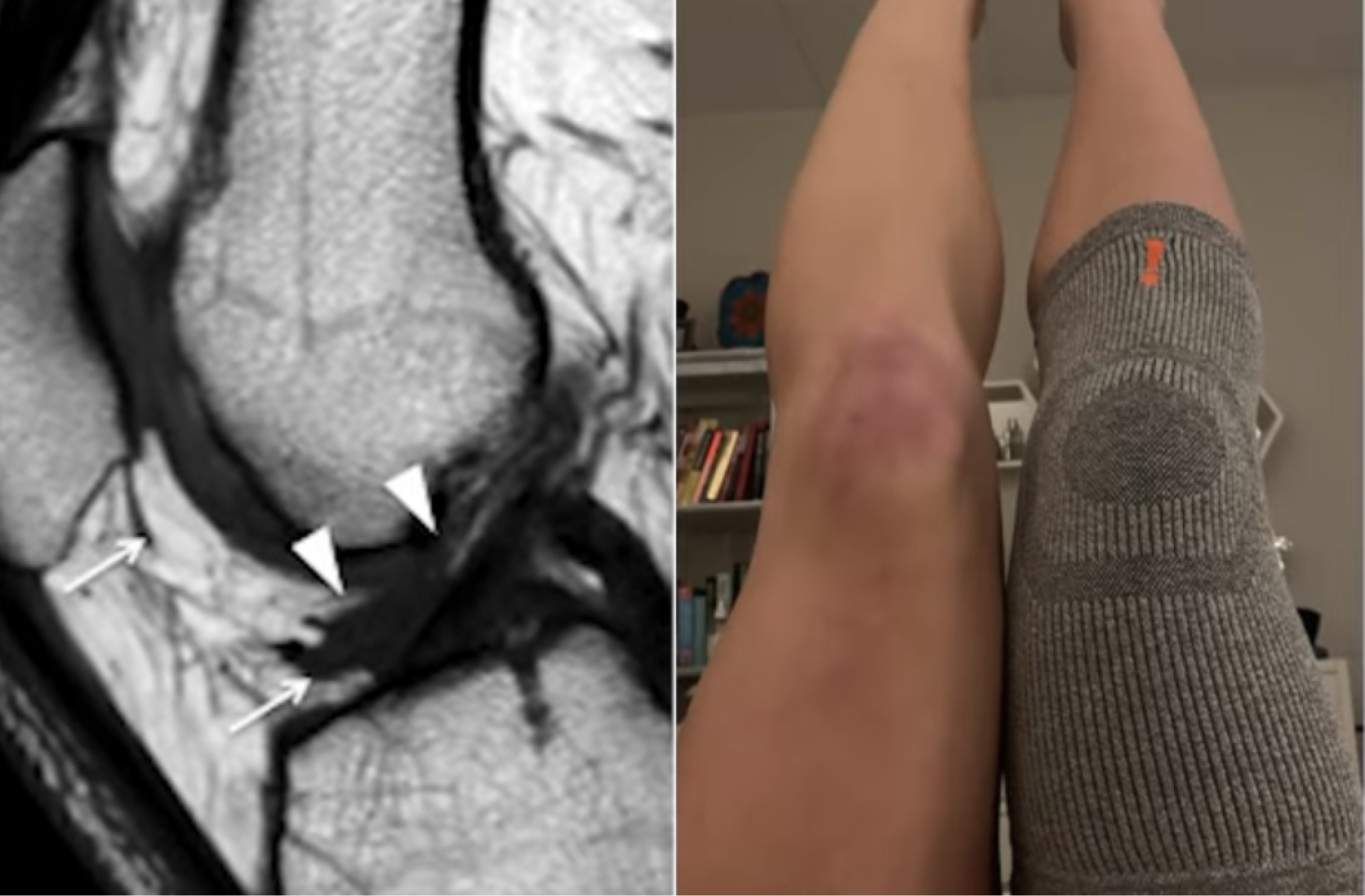 A split image showing a knee MRI scan next to a photo of two human knees.