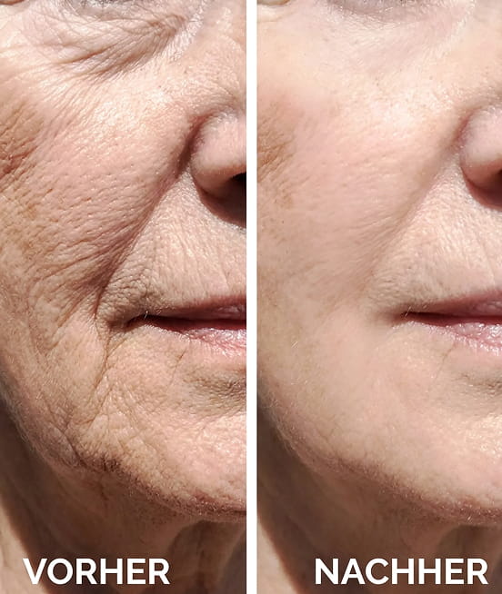 A side-by-side comparison image showing a close-up of facial wrinkles before and after, with diminished wrinkles after.