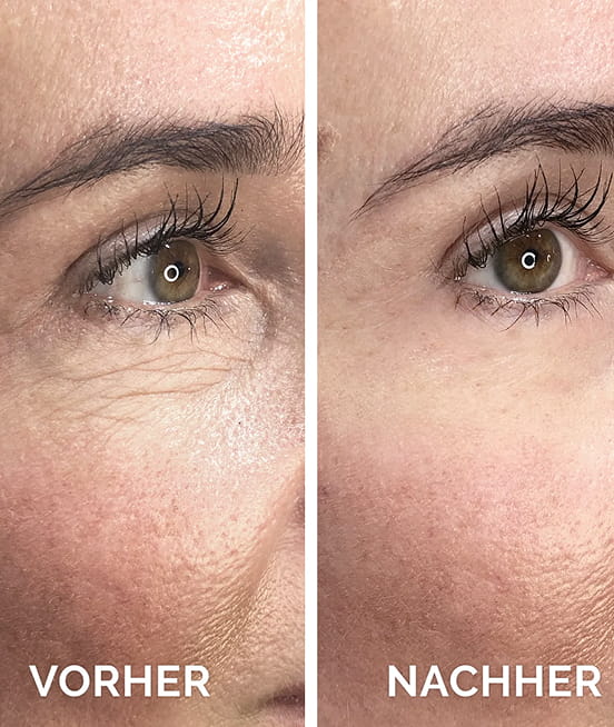 A before-and-after comparison showing a reduction of wrinkles and fine lines around a person's eye.