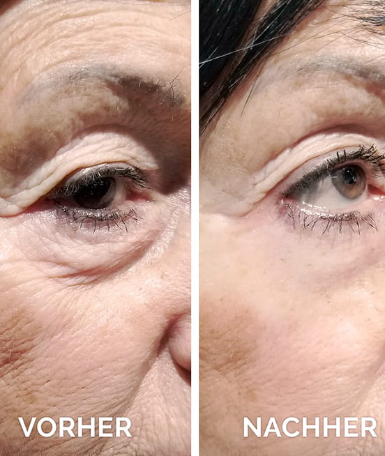 A before and after close-up of an eye, showing a reduction in wrinkles and fine lines.