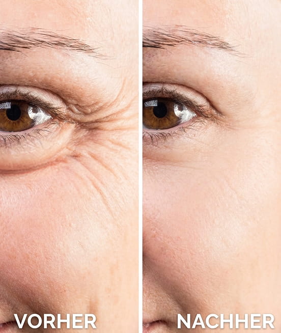A before and after comparison showing the reduction of wrinkles around a person's eye.