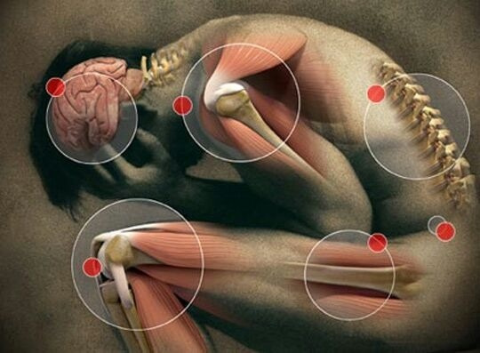 Anatomical illustration of a person in a fetal position, with callouts showing the brain, joints, and spine.