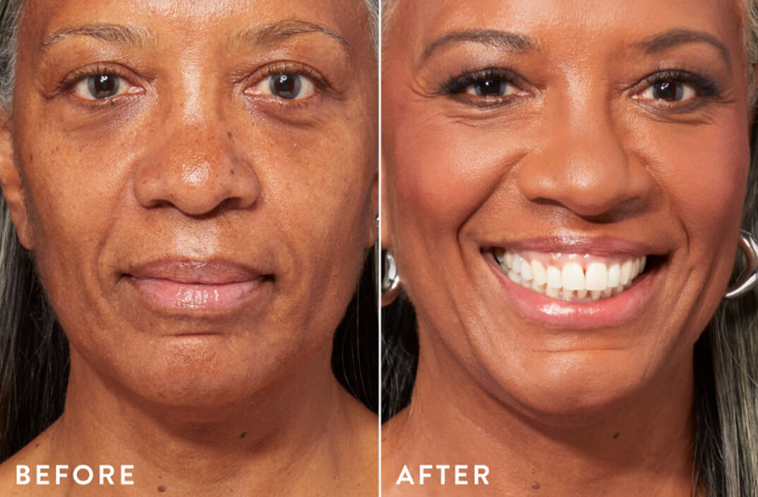 Side-by-side skincare transformation showing before and after results.