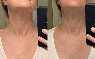 A side-by-side comparison image showing a close-up of a woman's neck and chest area.