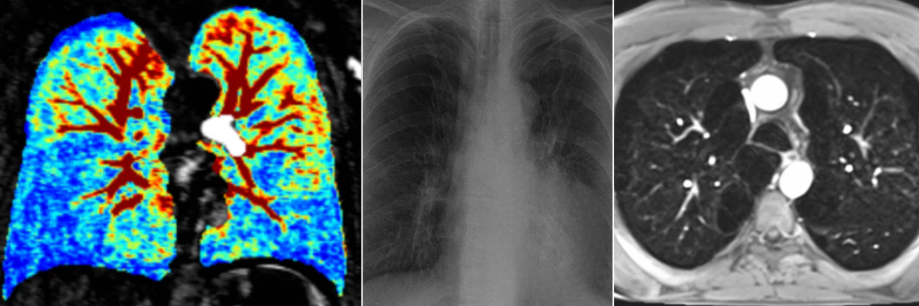 A composite image showing three different types of medical scans of a human chest and lungs.