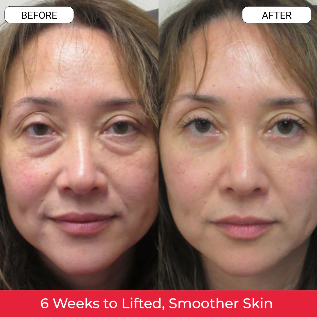 A before and after comparison of a woman's face, showing a reduction in wrinkles and smoother skin.