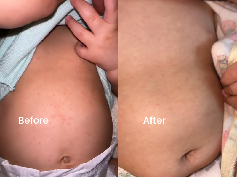A before and after comparison of a rash on a baby's stomach, showing improvement.