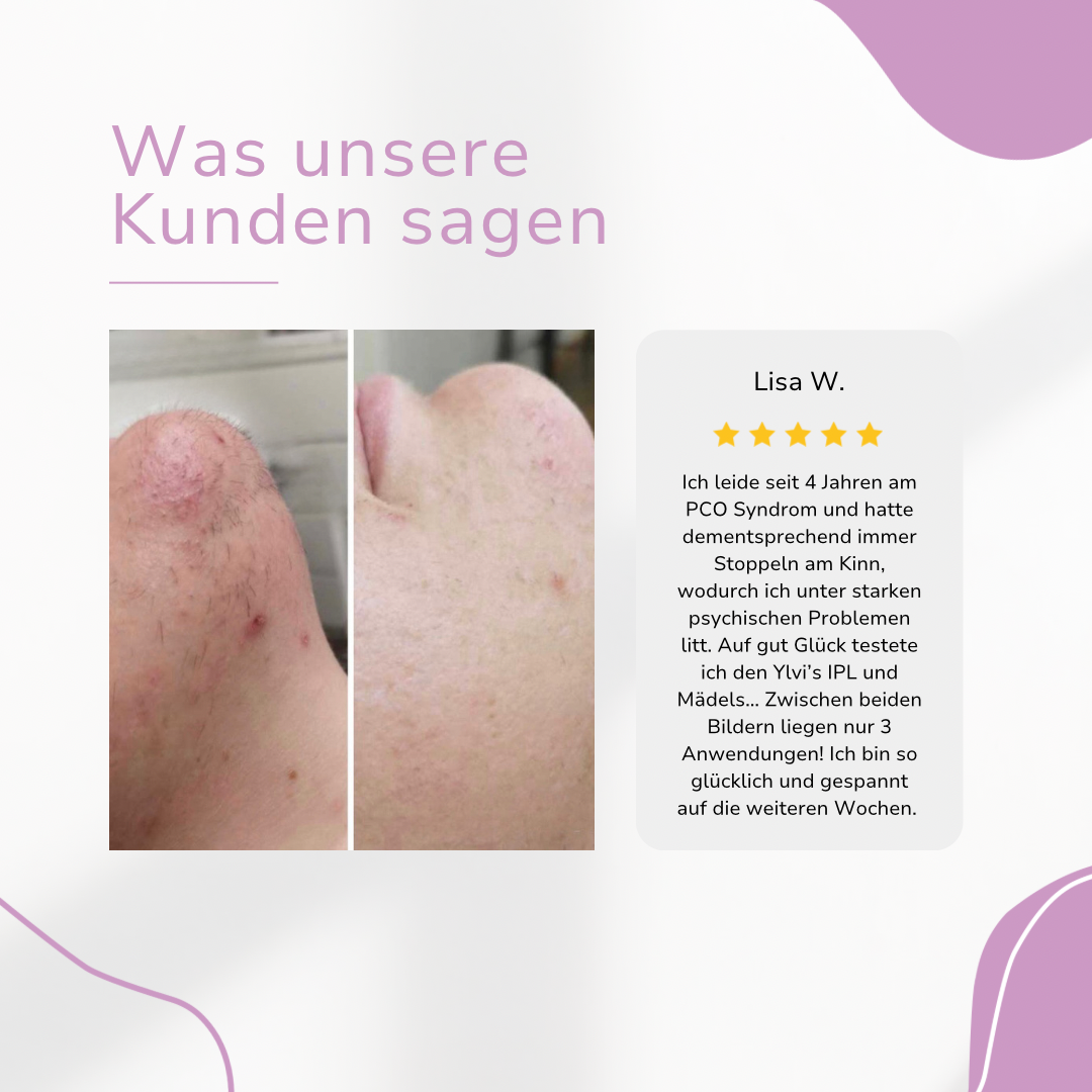 Before and after images of skin treatment with text review in German.