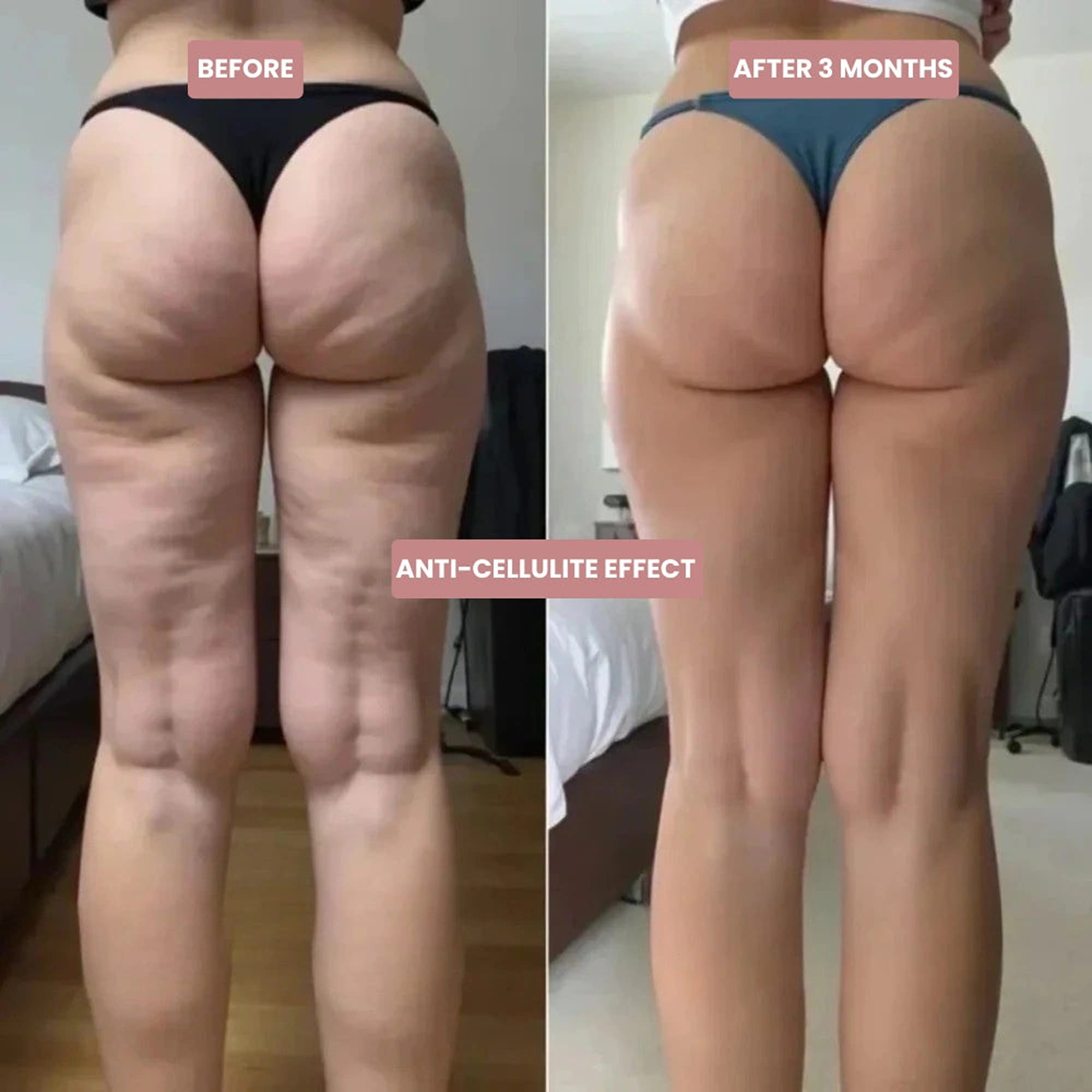 A before and after comparison of a woman's buttocks and thighs, showing a reduction in cellulite.