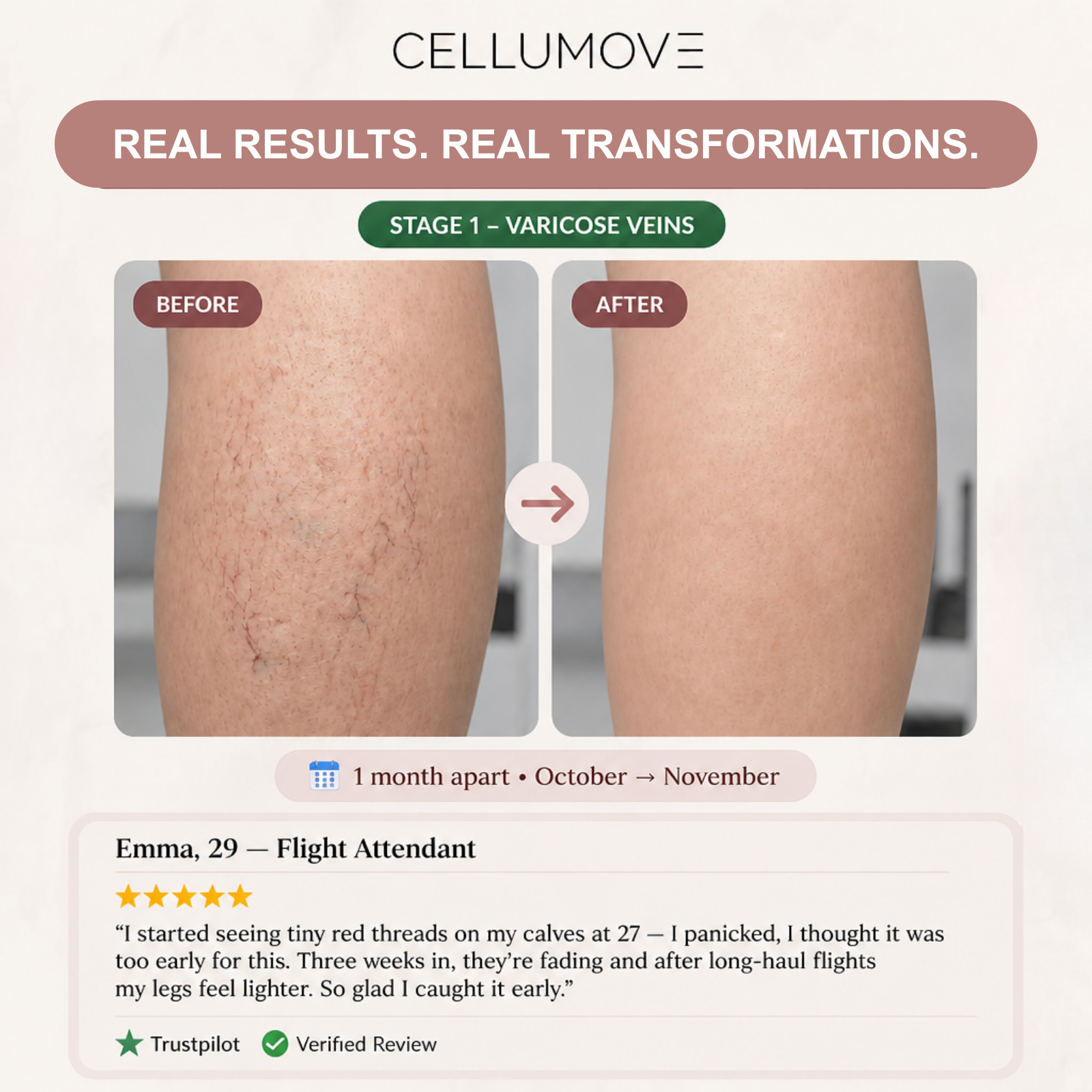 A before and after image showing the reduction of varicose veins on the back of a leg.