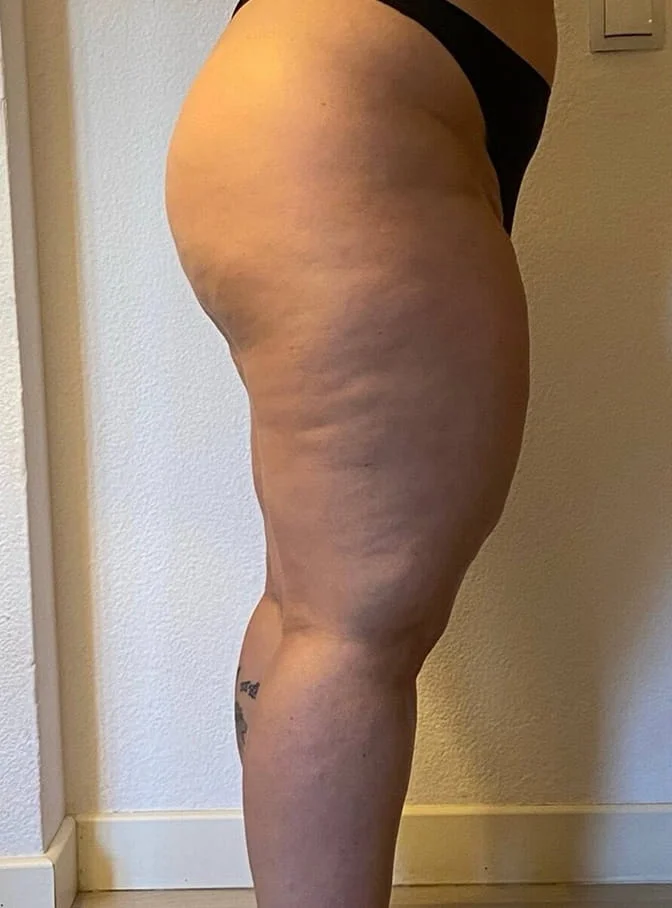 A side view of a person's leg, from the hip to the calf, showing cellulite on the thigh.