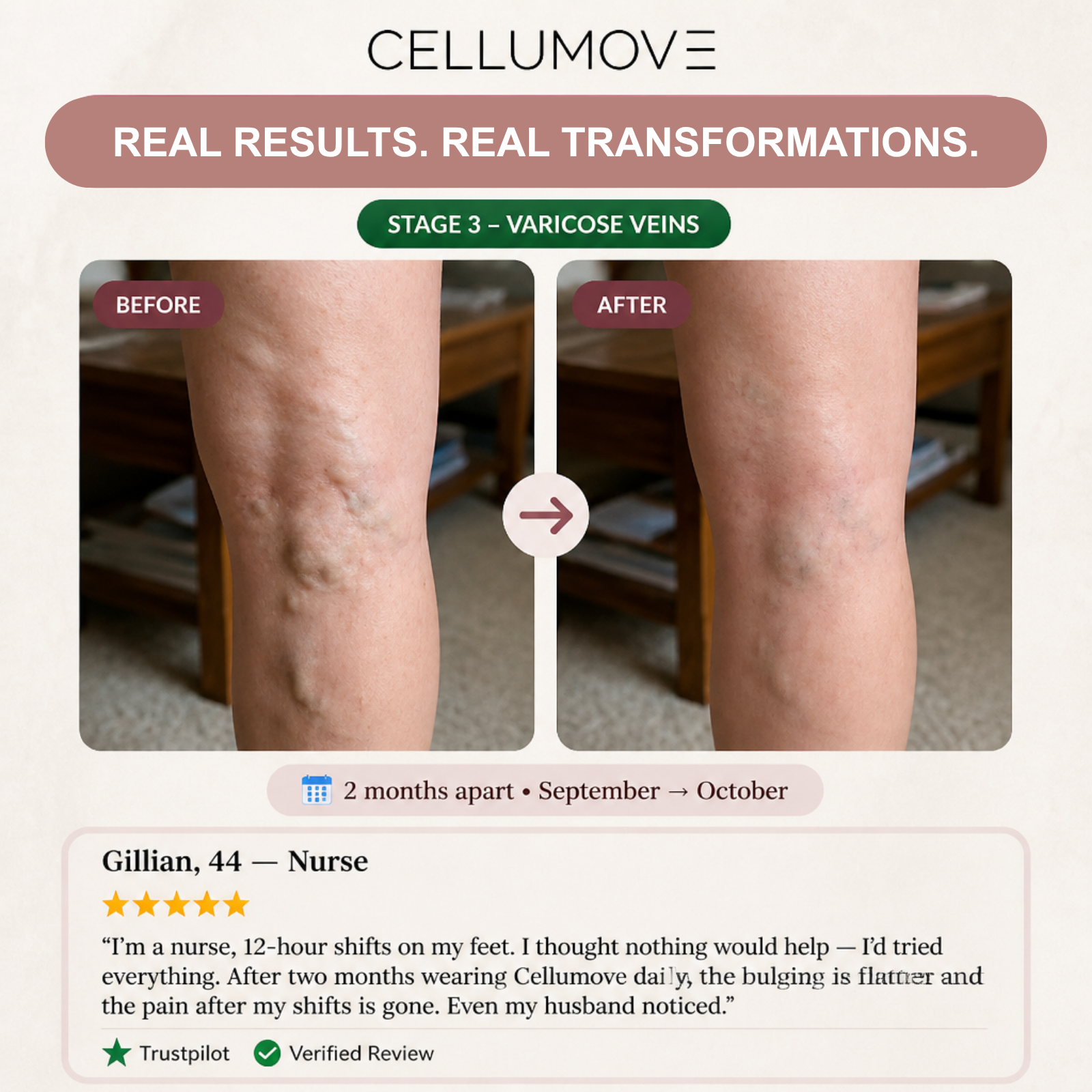 A before and after image showing the reduction of varicose veins on the back of a leg.