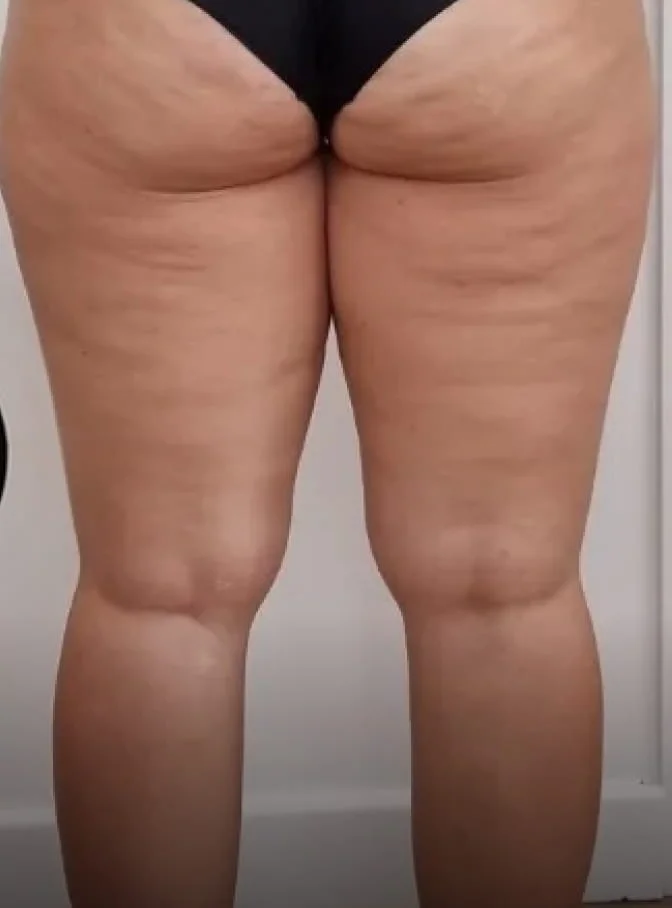 The back of a woman's thighs and buttocks showing cellulite.