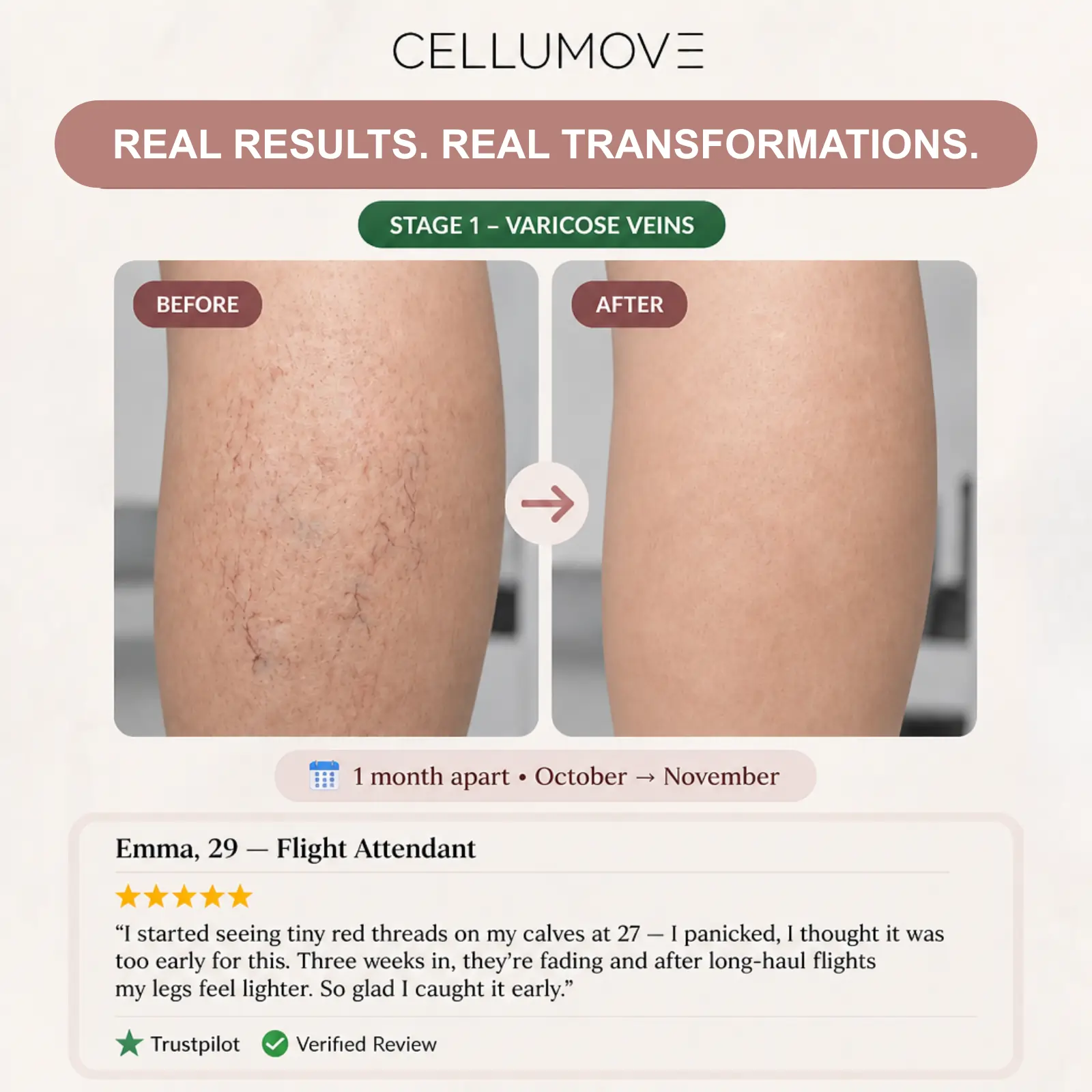 A before-and-after image showing a leg with a reduction in visible varicose veins after one month.