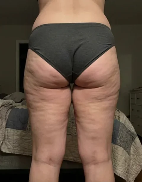 A rear view of a person's lower body, showing cellulite on the thighs and buttocks.