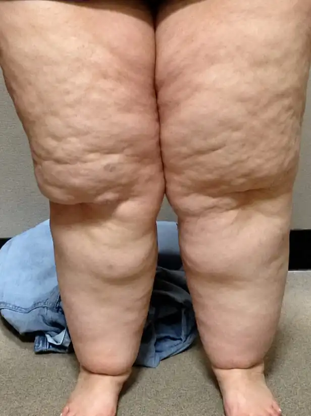 A close-up of a person's legs, from the thighs to the feet, showing significant swelling and lumpy skin.
