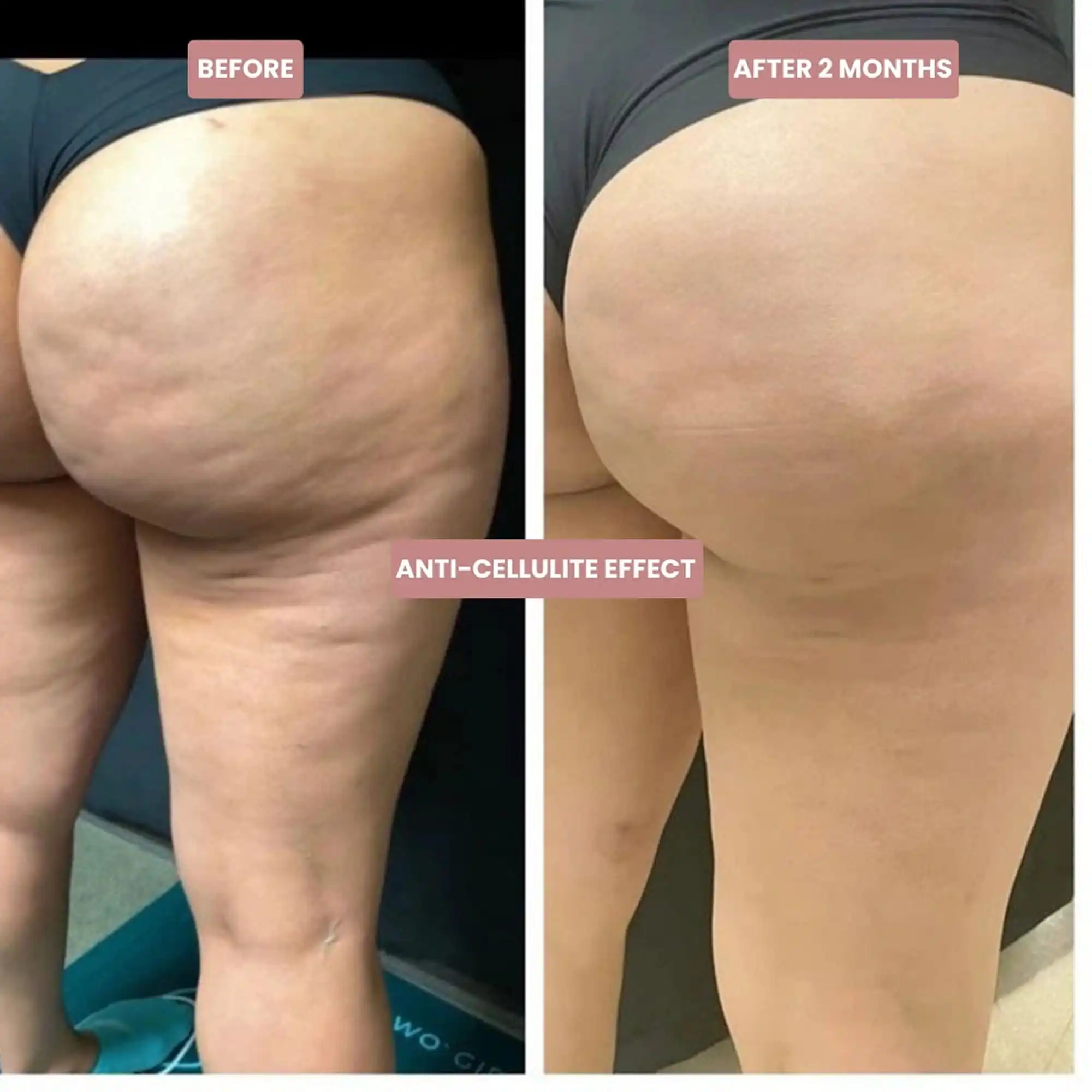 A before-and-after image showing a reduction in cellulite on a person's thighs and buttocks.