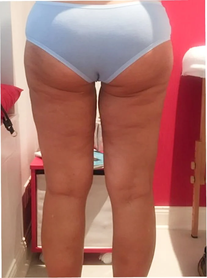 A rear view of a person's legs and buttocks in light blue underwear, showing cellulite.
