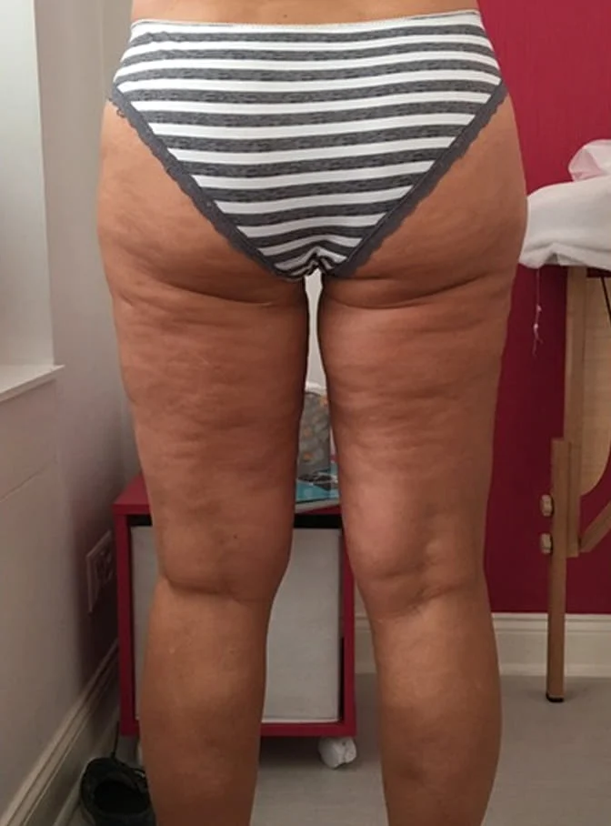 The back of a woman’s legs and buttocks in striped underwear, showing cellulite on the skin.
