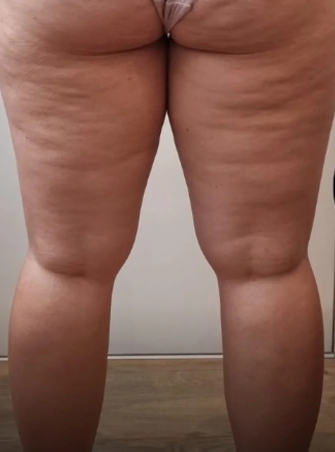 A rear view of a person's legs and buttocks, showing significant cellulite on the thighs.