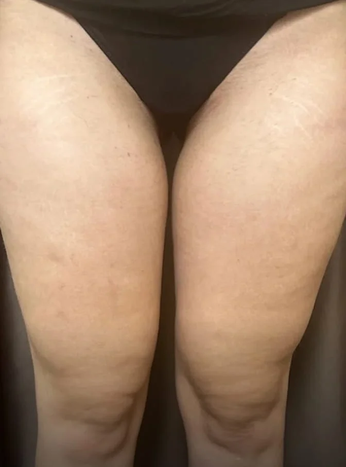 A close-up of a person's thighs showing visible stretch marks and skin texture.