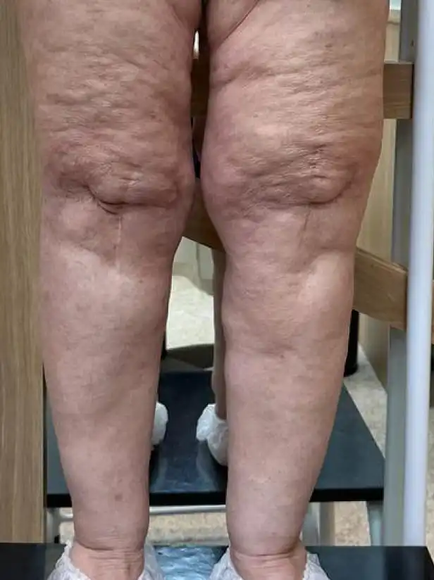 A rear view of a person's legs, showing loose and deeply folded skin on the thighs.