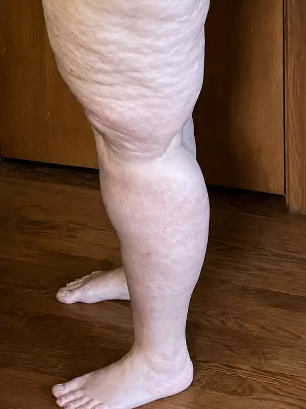 A side view of a person's leg with extensive loose, folded skin on the thigh.